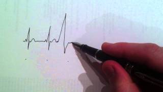 Cardiologist draws and explains the ECG of a ventricular ectopic beat [upl. by Dodge]