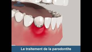 Le traitement de la Parodontite  Esthetic Hair Smile [upl. by Enicnarf]