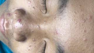 ACNE TREATMENT VU QUYNH MI  Blackheads On Boy Face 2024FULL [upl. by Doowrehs302]