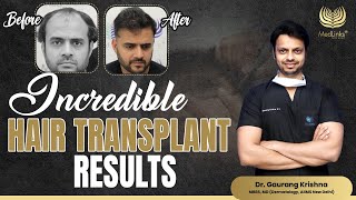 Incredible Hair Transplant Results  Medlinks [upl. by Aisela]