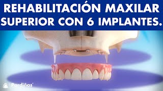 Dentadura fija  Rehabilitación del maxilar con 6 implantes © [upl. by Acinomal]