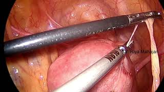 STEP 1  BOWEL AND OMENTAL ADHESIOLYSIS [upl. by Ardna]