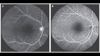 Vaskulitis der Retina bei Takayasu Arteriitis [upl. by Loise]