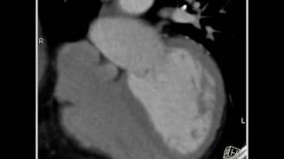 Cardiac left main coronary artery and bifurcation of LAD and circumflex 1 of 2 [upl. by Afihtan921]