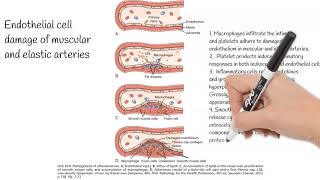 Atherosclerosis  Causes Pathogenesis Prevention [upl. by Ardnasirk]