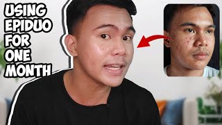 EPIDUO REVIEW  ACNE TREATMENT  1 MONTH USING EPIDUO  ADAPALENE  BENZOYL PEROXIDE [upl. by Argyle820]