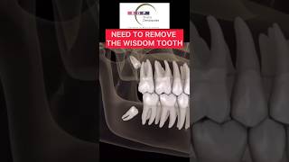 Why to remove Wisdom Teeth teeth teethpain wisdomtooth [upl. by Barcot]