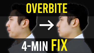 Overbite amp Overjet Fix｜Facial Asymmetry Correction｜Corrective Exercises [upl. by Ahtamat]