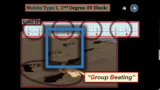 ECG Video8 Blog 105  AV Block 12512015 [upl. by Annoirb]