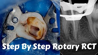 Live Steps Root Canal Rotary Protaper Endodontic Procedure ACP BMP obturation irrigation [upl. by Trubow498]