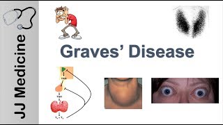 Graves Disease and Graves Ophthalmopathy  Signs Symptoms Diagnosis and Treatment [upl. by Eibloc]