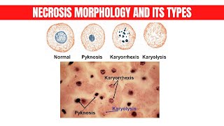 Necrosis Morphology and its types Part 3  Physio Class [upl. by Anonyw]