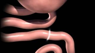 Roux en Y gastric bypass animation [upl. by Turnbull]