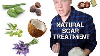 Alexs DIY All Natural Scar Treatment Tutorial [upl. by Ahtar]