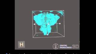 Examen de vias aereas usando CBCT Cone beam Carestream C9300Manuel Ruiz P mov [upl. by Jammin851]