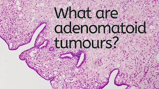 What are Adenomatoid Tumours  Pathology mini tutorial [upl. by Annitsirhc]