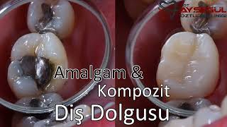 Kompozit Dolgu amp Amalgam Dolgu Kıyaslama  Diş Dolguları [upl. by Nerraf884]