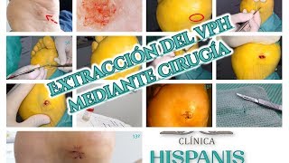 Extracción del VPH Virus del Papiloma Humano mediante cirugía [upl. by Anitnoc374]