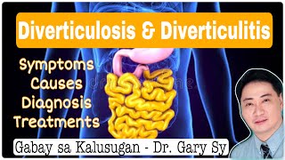 Diverticulosis and Diverticulitis Dr Gary Sy [upl. by Ikilisav]