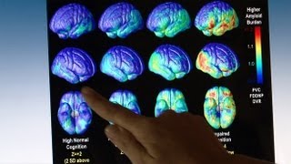 Alzheimers Diagnosis and Clinical Trials Heartache and Hope Americas Alzheimers Epidemic Ep 2 [upl. by Kerekes]