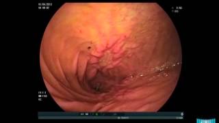 Obstructive Small Bowel Crohns Disease in Balloon Enteroscopy [upl. by Yatnuahs]