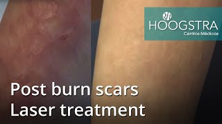 Post burns scars  Laser treatment 21019 [upl. by Seluj]