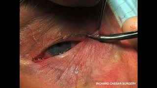 Lower Eyelid Ectropion  A Practical Approach [upl. by Oremar]