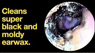 Cleans super black and moldy earwax ear wax removal  ear cleaning  ASMR  relaxation  relax [upl. by Savage]