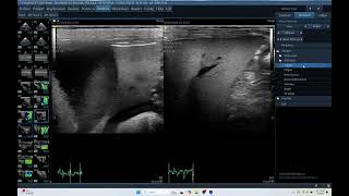 IQ 174 LIVER HEPATOMA LT LOBE ECHOCARDIOGRAPHY ECHOPAC ANALYSIS HEPATOMA PDH CORTISOL 89 [upl. by Mattland]