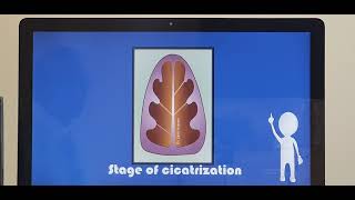 Rhinoscleroma Tamil Patient teaching programme [upl. by Ayotl]