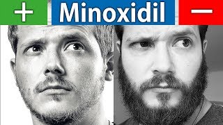 Die Vor und Nachteile von Minoxidil  Kurz und Knapp [upl. by Brelje]