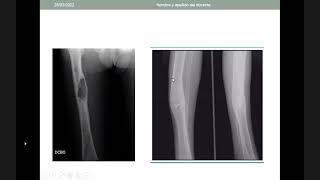 INFECCIONES OSTEOARTICULARES [upl. by Xuaegram]