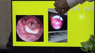 Acute Epiglottitis  ENT EMERGENCY  Hindi  Patient teaching programme [upl. by Janelle]