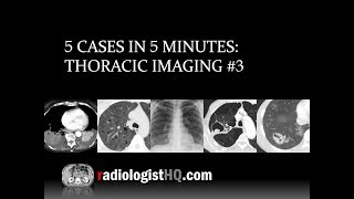 5 Cases in 5 Minutes Thoracic 3 [upl. by Jarlathus51]