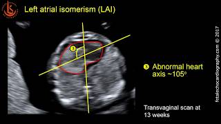 Fetal echocardiography at 1113 weeks Left Atrial Isomerism LAi amp Congenital Heart Block [upl. by Flory]