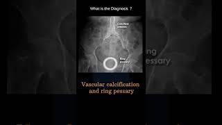 Vascular calcification amp ring pessary 13 Abdominal Xray System and anatomy radiologychannel007 [upl. by Yerhpmuh]