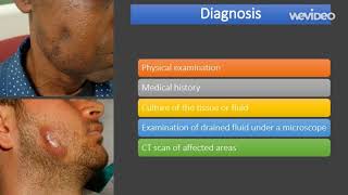 actinomycosis  causes diagnosis treatment comp [upl. by Aizti]