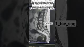 MRI Spine Showing Diffuse disc bulge t1tsesag Sequence beginners [upl. by Rakia612]