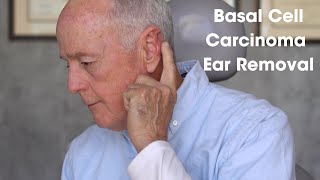 Basal Cell Carcinoma Ear Removal Patient Testimonial Part 1 [upl. by Billie]