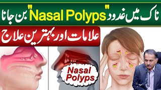 Gadood in Nose OR Nasal Polyps  Symptoms and Treatment of Nasal Polyps  Nose Polyps Ka ilaj [upl. by Aeslahc424]