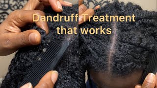 Try This Dandruff Treatment See Change in 1 Week  DiscoveringNatural [upl. by Ydnil]