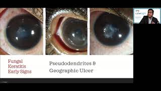 Lecture Microbial Keratitis Update for General Ophthalmologists [upl. by Imoyaba2]