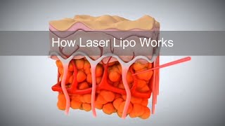 How Laser Lipo Works to Release Fat and Reduce Cellulite [upl. by Lennie]