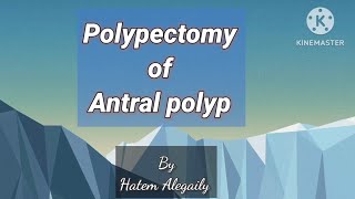 polypectomy for antral polyp httpsyoutubecommedicalsnacks1526sixnTpwYfQM4RstEgQ [upl. by Sesom]