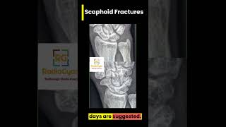 Scaphoid Fractures  Why is it important to diagnose  Shorts [upl. by Nerok]