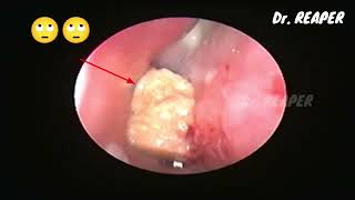 CASE NO 07  WHATS THIS THING INSIDE NOSE 😮  F B REMOVAL  NASAL ENDOSCOPY [upl. by Aleemaj881]