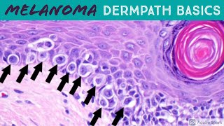 Melanoma vs Nevus Microscopic Clues for Malignancy Explained in 5 Minutes [upl. by Rust]