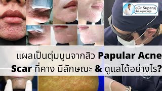 แผลเป็นตุ่มนูนจากสิว Papular Acne Scar ที่คาง มีลักษณะ amp ดูแลได้อย่างไร [upl. by Anaidirib]