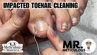 How to Fix Ingrown  Impacted Toenails at Home nails satisfying [upl. by Naujek238]