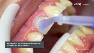 Descubra o poder do Whiteness HP Automixx 6 para clareamento dental em pacientes jovens ✨💫 [upl. by Gwendolen]